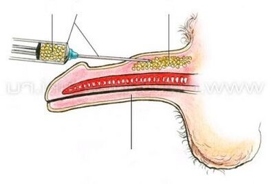 تكبير القضيب عن طريق الحقن